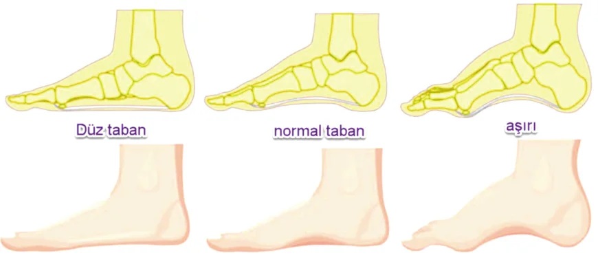 Visual differences between normal foot structure and pes planus.
